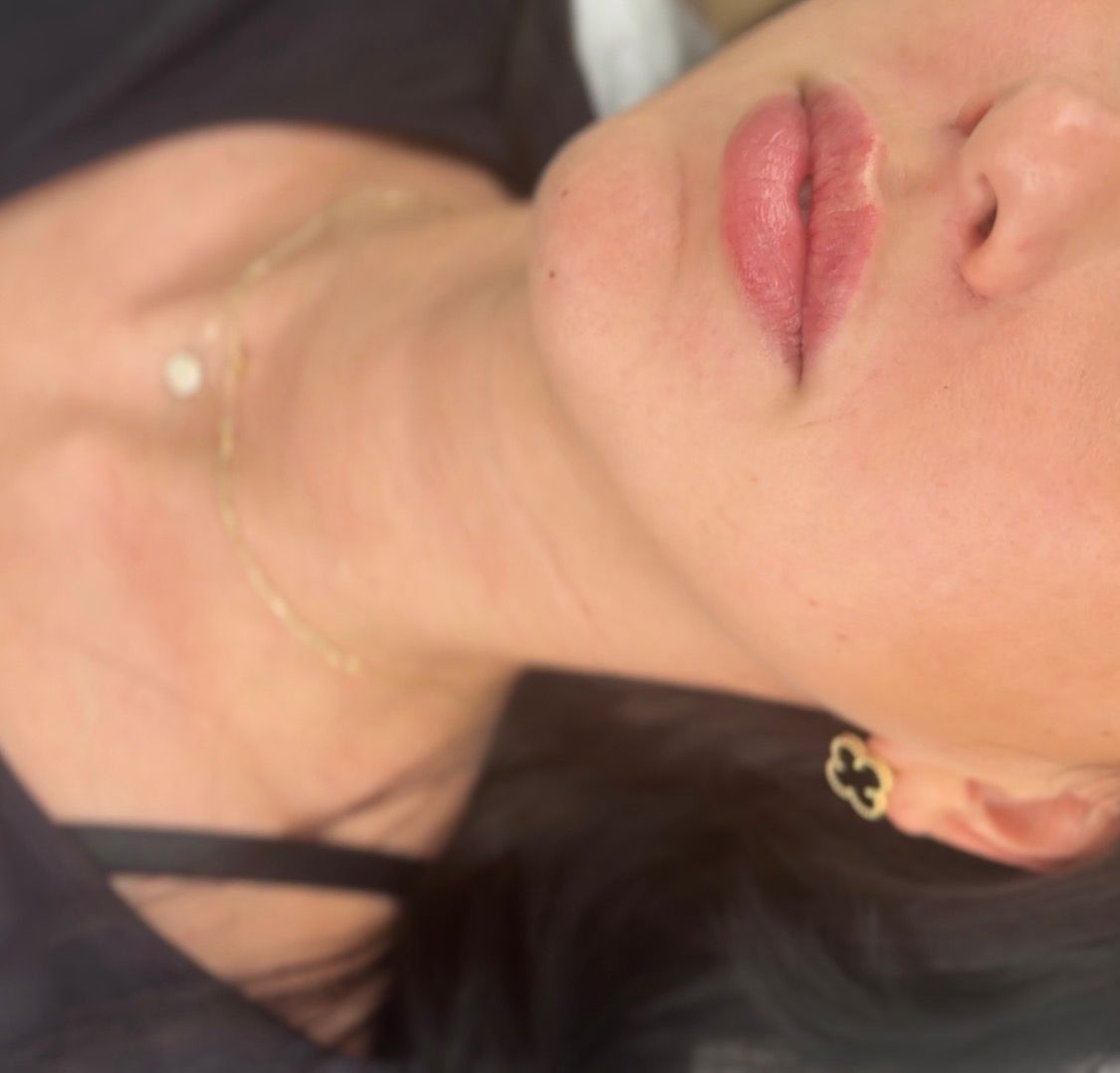 Lippen-Unterspritzung – Ergebnis natürlich definiert