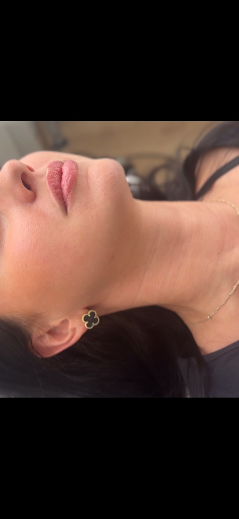 Russian Lips – natürliche Lippenunterspritzung mit Hyaluron